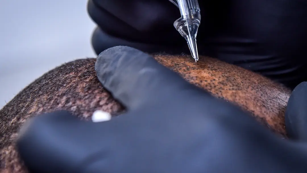 scalp micropigmentation håravfall